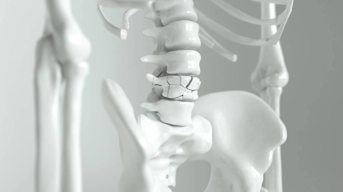 Unlocking the Secrets of Strong Bones: Beyond Bone Density